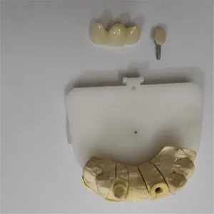 Emax bridge with post core – case by Well Dental Lab