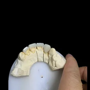 Emax veneer – case by Well Dental Lab