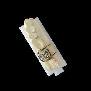 Gold crown – case by Well Dental Lab