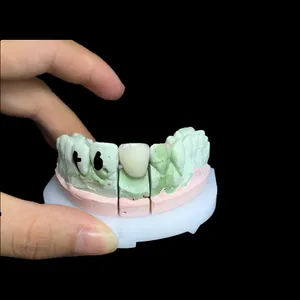 Emax crown – case by Well Dental Lab