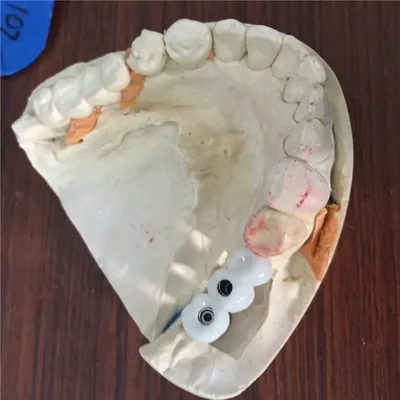 Zirconia implant bridge – case by Well Dental Lab
