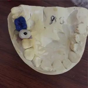 Implant crown with wax up – case by Well Dental Lab