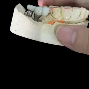 Implant bridge – case by Well Dental Lab
