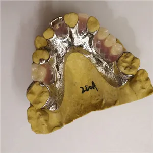 Metal framework with gold tooth – case by Well Dental Lab