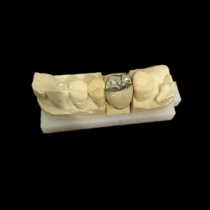 PFM – case by Well Dental Lab (3)