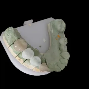PFM and wax up – case by Well Dental Lab