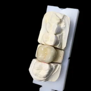 PFM crown – case by Well Dental Lab