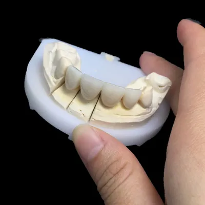 PFM – case by Well Dental Lab
