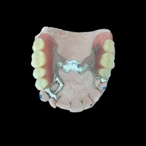 Metal framework – case by Well Dental Lab (3)