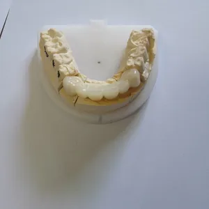 Temporary bridge – case by Well Dental Lab