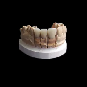 Emax crown – case by Well Dental Lab (2)