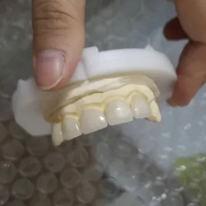 Emax veneer – case by Well Dental Lab (2)