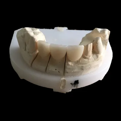 Zirconia crown – case by Well Dental Lab